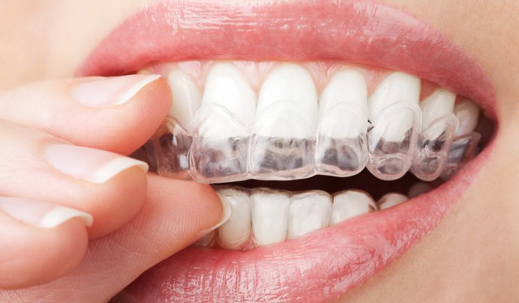 Phương pháp chỉnh nha niềng răng mới đảm bảo tính thẩm mỹ cao