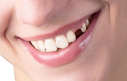 Trồng răng Implant – giải pháp tối ưu cho người bị mất răng
