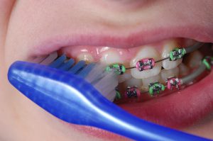 Hướng dẫn vệ sinh răng miệng khi niềng răng