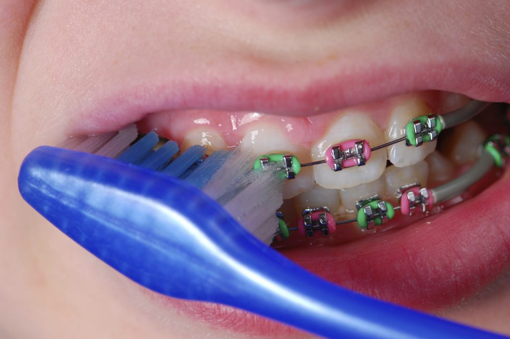 Vệ sinh răng miệng sạch sẽ sau khi ăn uống 