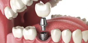 Chi phí trồng răng implant mới nhất