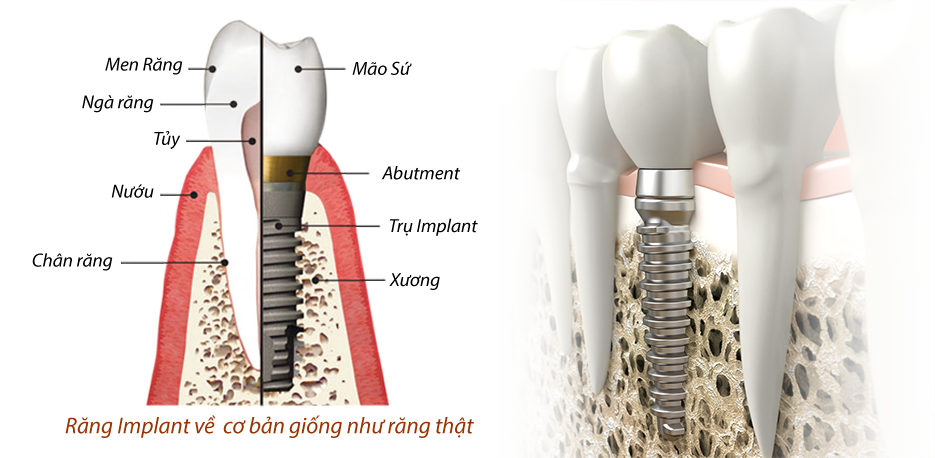 Trồng răng Implant – thành tựu của khoa học hiện đại