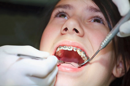 lưu ý trong quá trình niềng răng