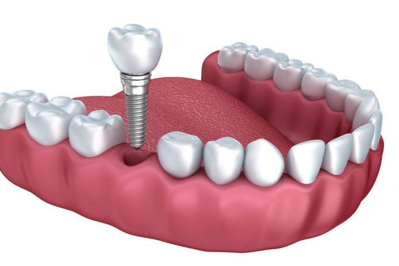 Trồng răng giả có ảnh hưởng gì đến sức khỏe răng miệng không?