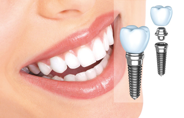 trồng răng Implant