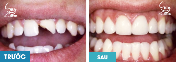 trước và sau khi bọc răng sứ tại nha khoa Đông Nam Á