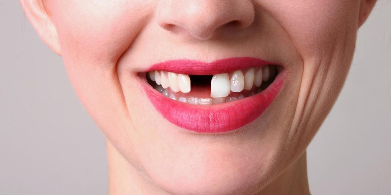 Tác hại khôn lường khi trì hoãn trồng răng giả