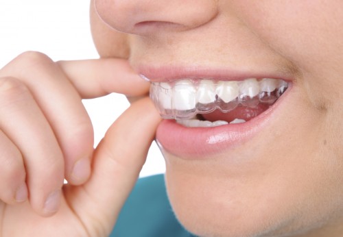 Phương pháp niềng răng bằng khay Invisalign