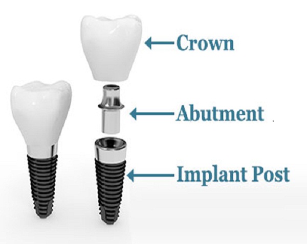 cấu tạo răng cấy ghepsp Implant