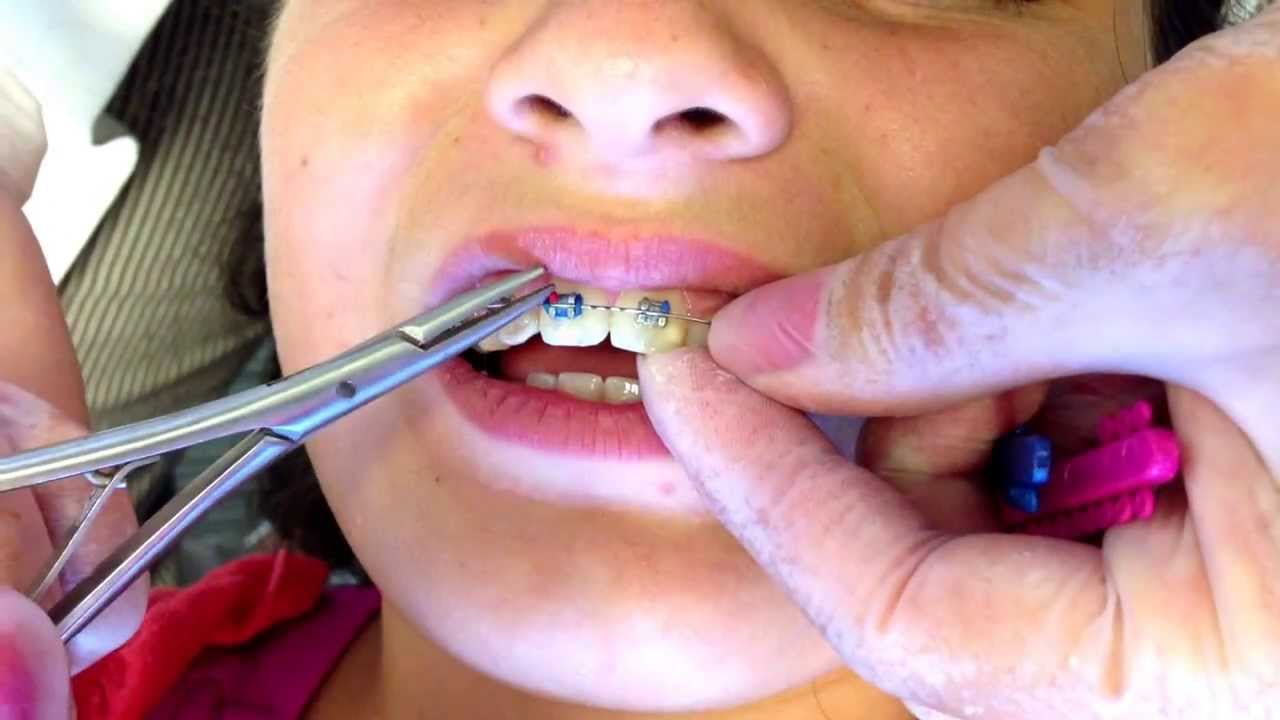 Phân loại chi tiết các trường hợp cần niềng răng