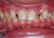 hình dạng răng dị thường