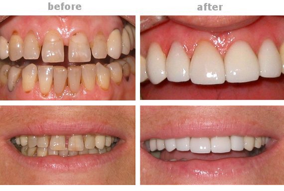 Bọc sứ răng cửa – Xu hướng thẩm mỹ răng phổ biến nhất