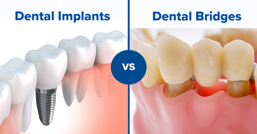 Nên trồng răng Implant hay trồng răng cầu răng sứ