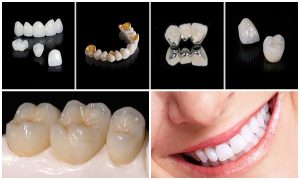 Tưởng đắt hơn, nhưng răng toàn sứ hóa ra lại rẻ hơn răng sứ kim loại