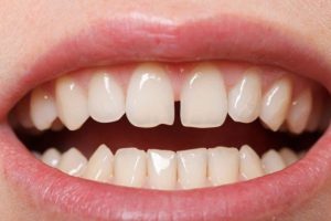 Giải pháp  nào cho răng thưa ? Bọc răng sứ hay niềng răng ?