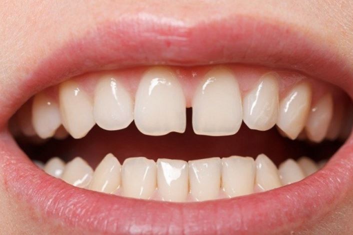 Bọc răng sứ hay trám răng ? Giải pháp nào cho răng thưa ?