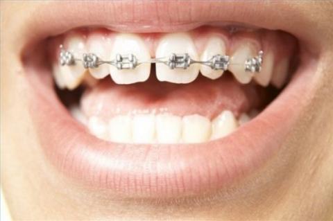Niềng răng giúp cải thiện các khuyết điểm của răng