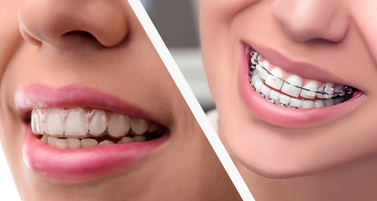 Niềng răng bao lâu để có hàm răng đều đẹp?