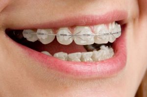 Niềng răng không nhổ răng có đạt được hiệu quả?