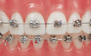 Niềng răng mắc cài kim loại tự buộc có thực sự hiệu quả?