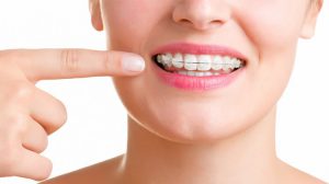 Niềng răng mắc cài sứ mất bao lâu hiệu quả?