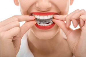 Niềng răng không mắc cài – Niềng răng công nghệ mới