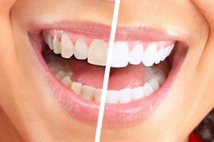 Bọc răng sứ Nacera – Giải pháp phục hình răng tối ưu