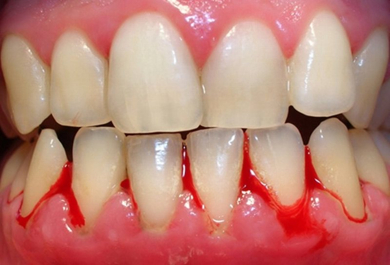bệnh viêm chân răng là gì