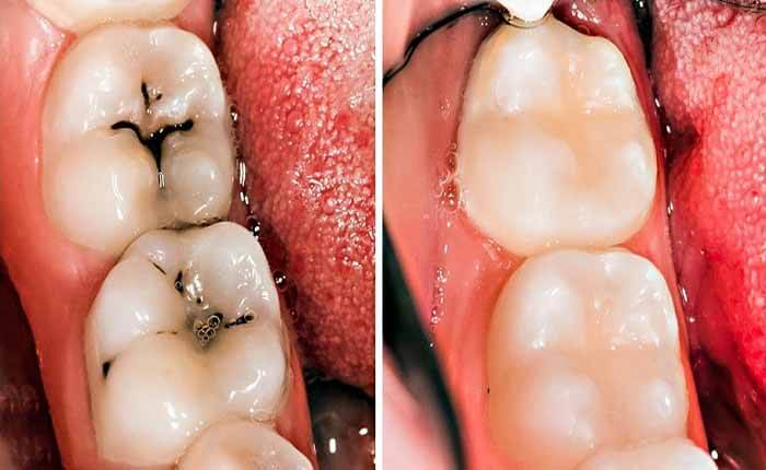 bọc răng sứ có dẫn đến bị sâu răng hay không