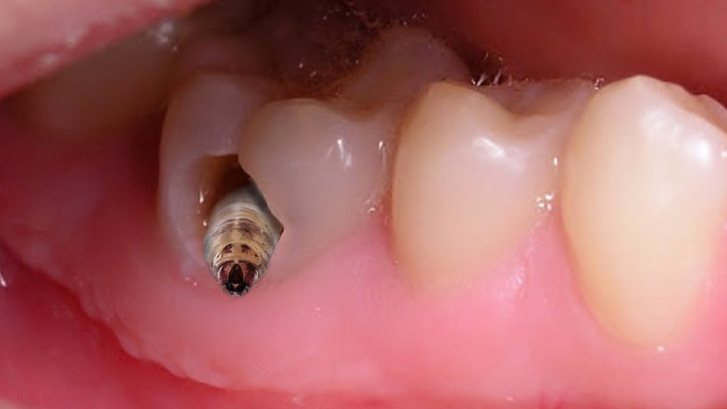 bọc răng hàm bị sâu