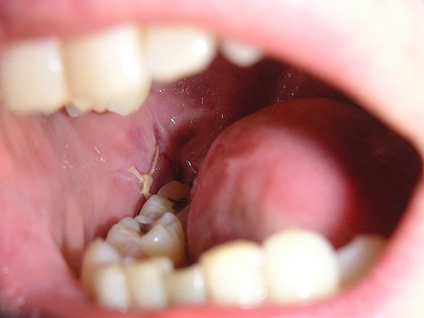 các tình trạng xuất hiện sau khi nhổ răng khôn