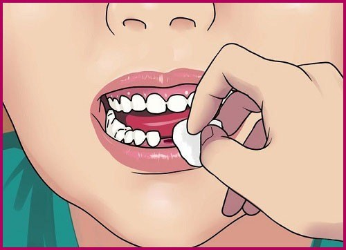 chăm sóc bản thân sau khi nhổ răng khôn