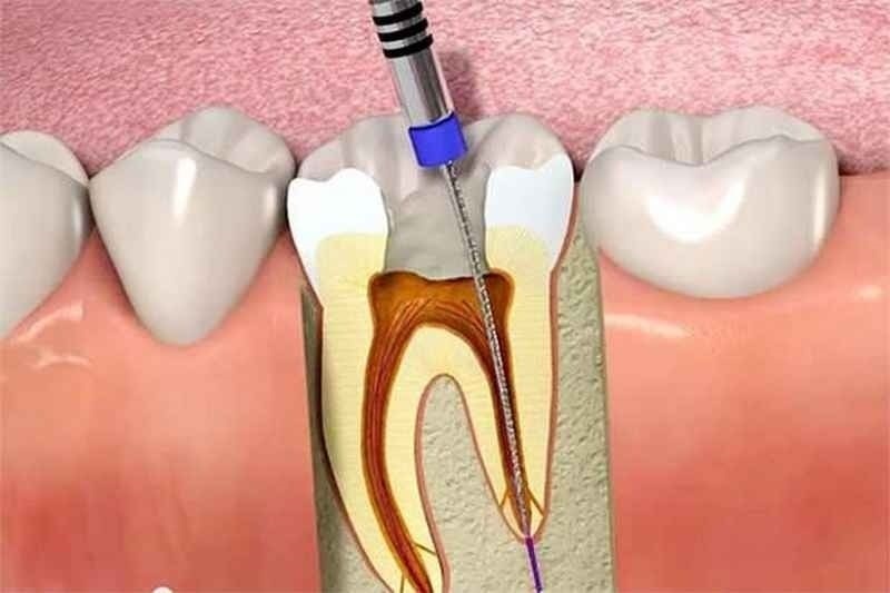 chữa tủy răng là gì