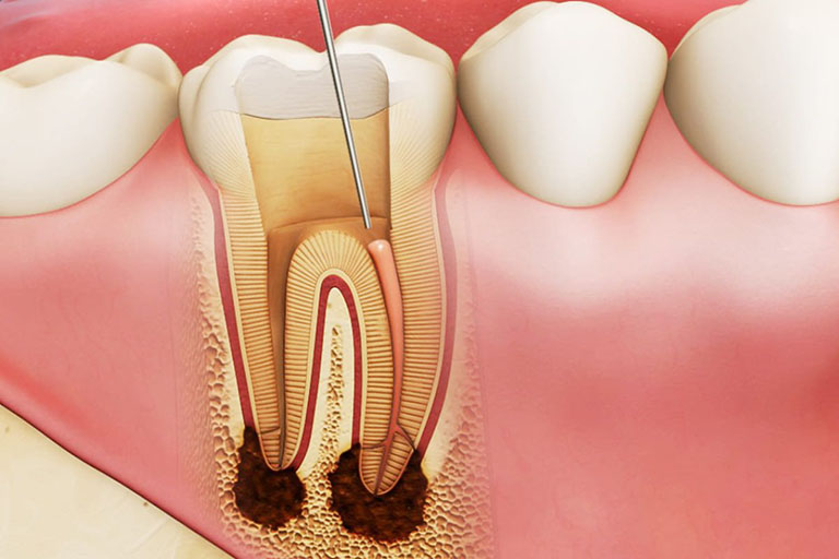 quy trình chữa tủy răng