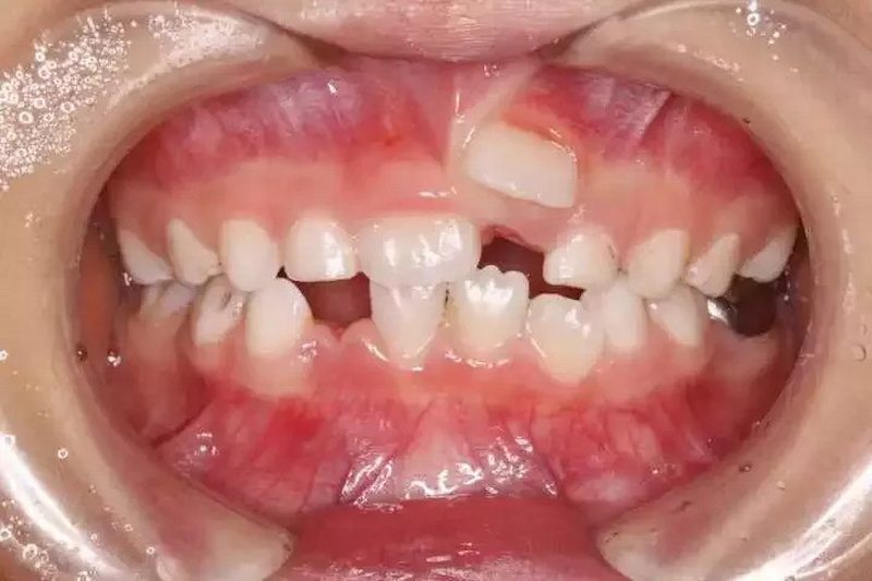 răng mọc lệch ở trẻ