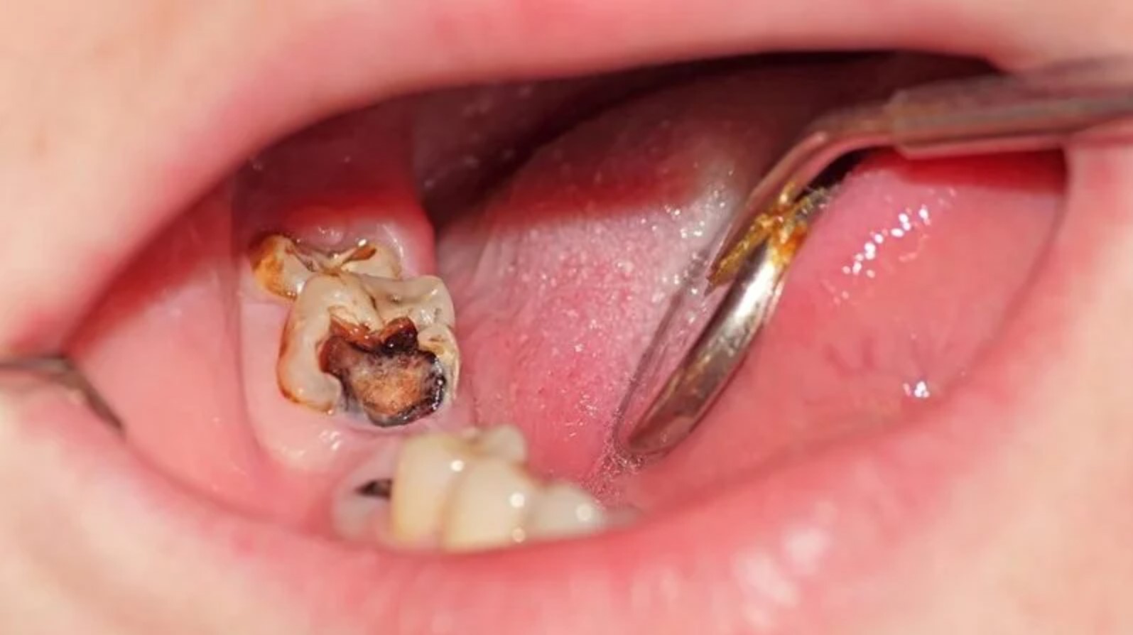 răng số 6 bị viêm tủy nặng