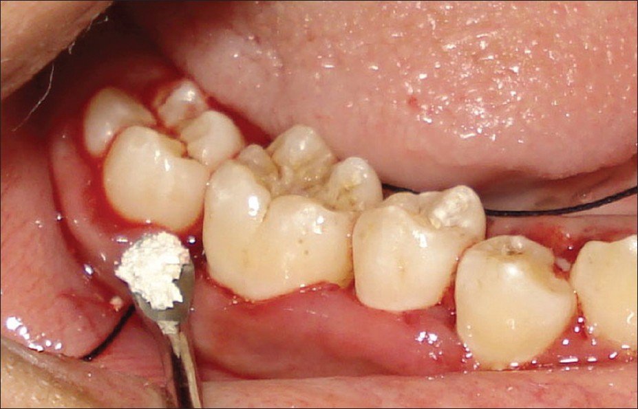 tại sao răng số 6 hay bị sâu, tổn thương