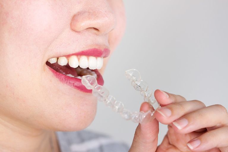 ưu điểm của phương pháp niềng răng trong suốt