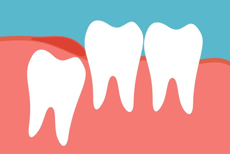 răng khôn mọc bình thường