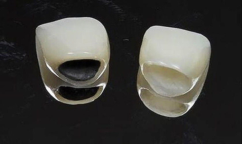 răng kim loại