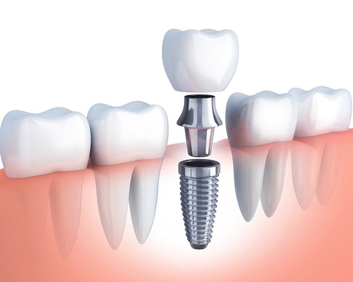 LIỆU CÓ NÊN TRỒNG RĂNG IMPLANT GIÁ RẺ HAY KHÔNG?