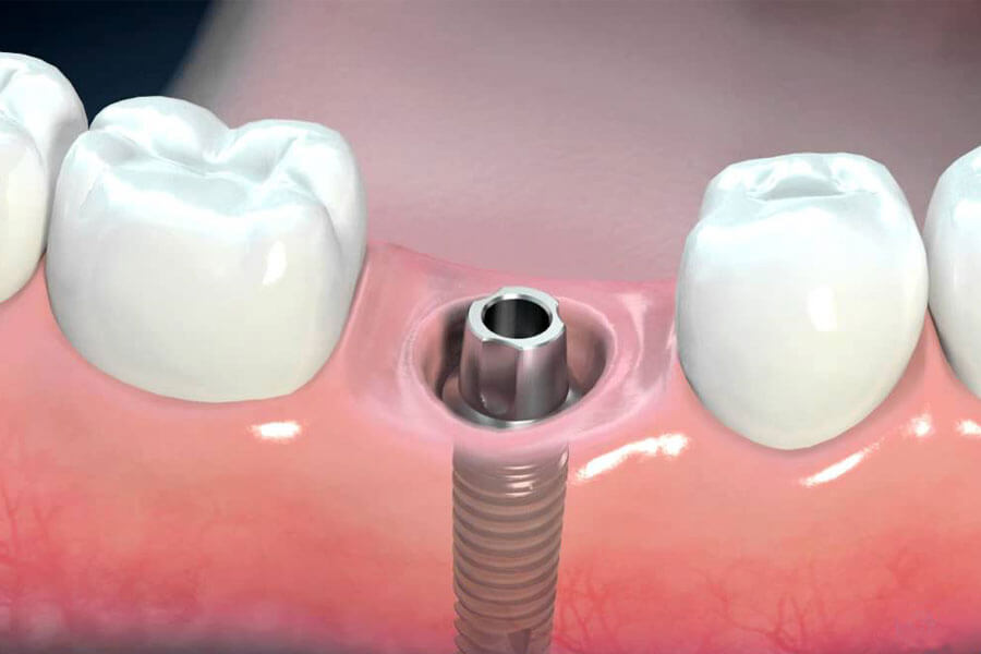 trồng implant