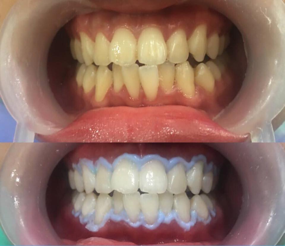 kết quả khi tẩy răng laser whitening