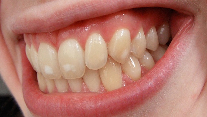 bề mặt răng có đốm trắng đục