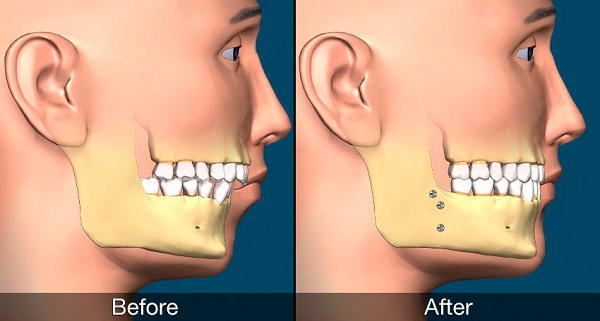 CÁC GIAI ĐOẠN NIỀNG RĂNG CẦN BIẾT, BẠN ĐANG Ở GIAI ĐOẠN NÀO?