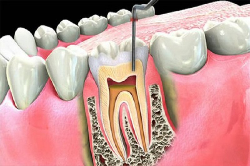 BÍ QUYẾT GIÚP CHỮA TỦY RĂNG BỊ ĐAU AN TOÀN VÀ HIỆU QUẢ