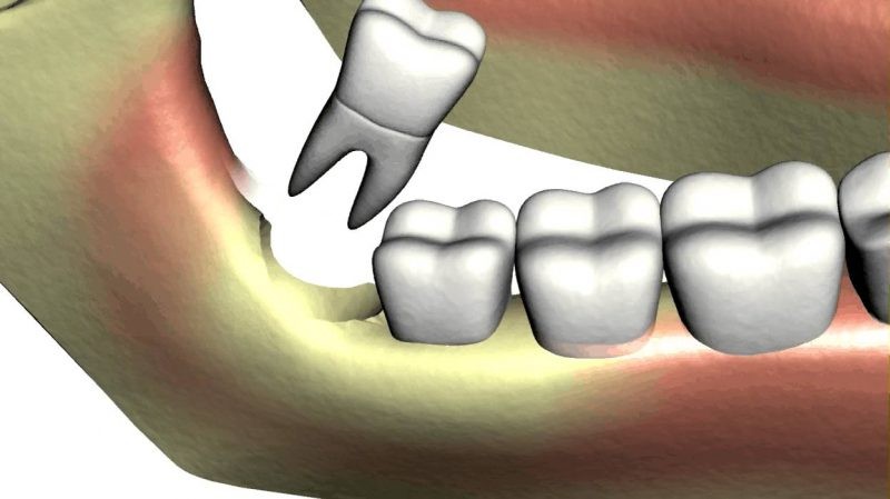 răng khôn mọc lệch 45 độ (1)