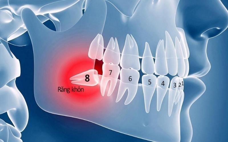 RĂNG KHÔN MỌC LỆCH 45 ĐỘ NHỔ SAO CHO AN TOÀN NHẤT ?