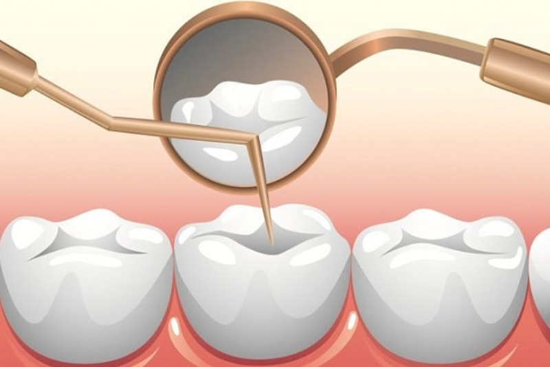 KHÁM PHÁ QUY TRÌNH TRÁM RĂNG ĐẠT CHUẨN NHẤT LƯỢNG HÀNG ĐẦU HIỆN NAY