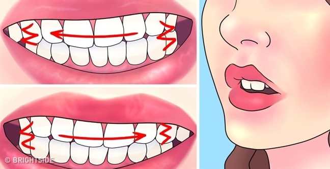 nguyên nhân nghiến răng